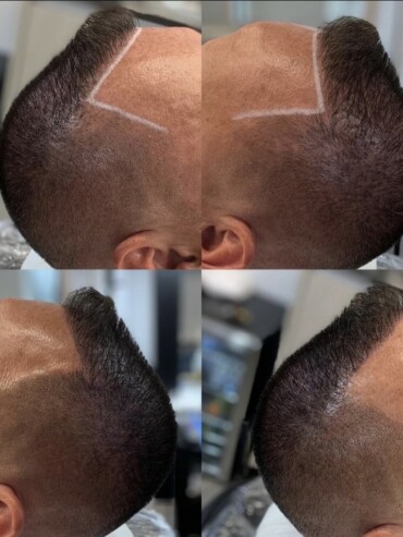Hairline Improvement SMP